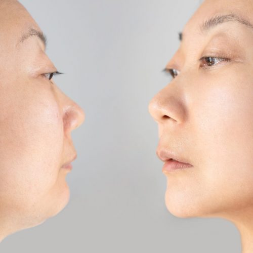 Part,Of,Face,,Asian,Woman,With,Double,And,Perfect,Chin