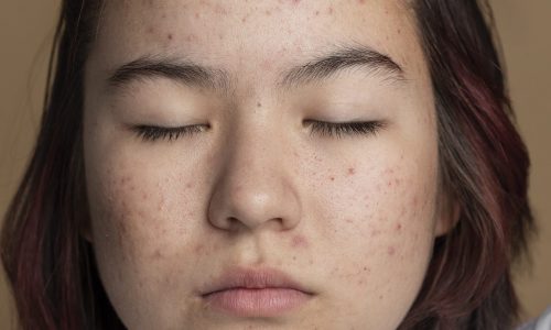 Picture of a lady with acne prone skin