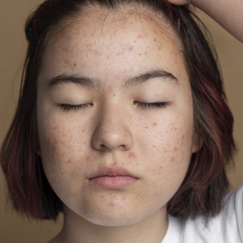 Picture of a lady with acne prone skin